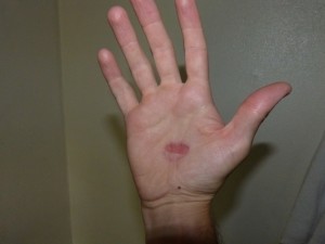 Work wound